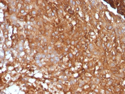 FFPE human melanoma sections stained with 100 ul anti-Beta-2 Microglobulin (clone B2M/961) at 1:300. HIER epitope retrieval prior to staining was performed in 10mM Citrate, pH 6.0.